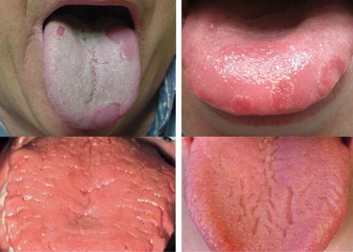 Nhiệt miệng ở lưỡi: nhiệt lưỡi uống thuốc gì?